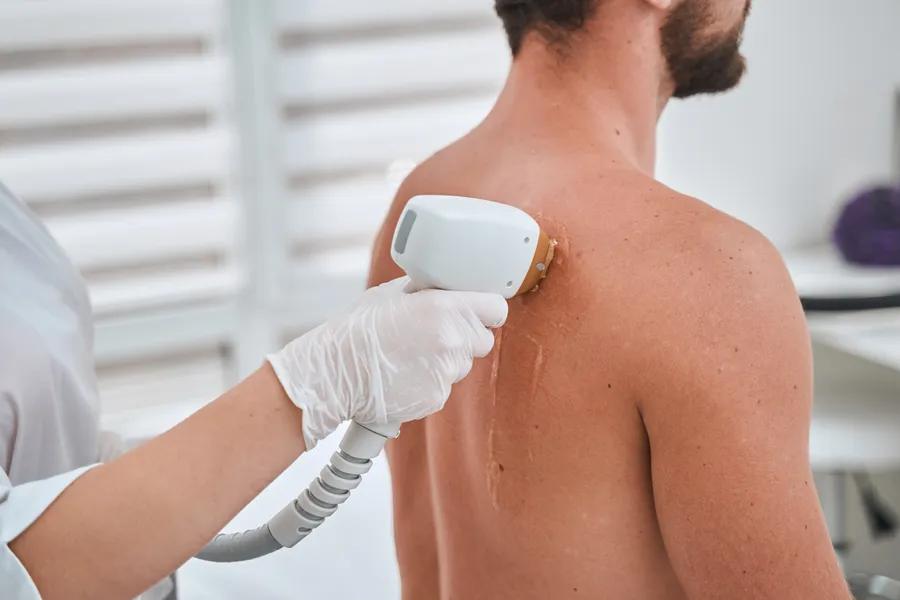 Chest & Back laser hair removal at Aries Clinic Dubai