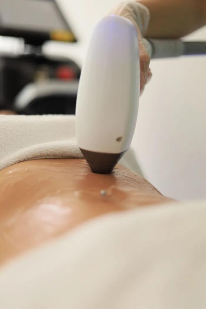 Full Body laser hair removal at Aries Clinic Dubai