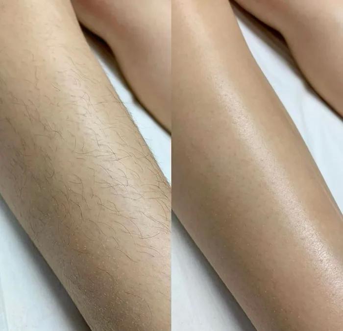 Legs laser hair removal before and after - illustrative