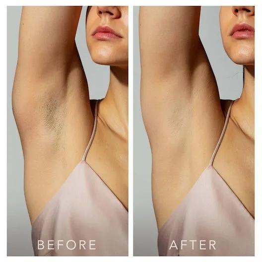 Underarms laser hair removal before and after - illustrative