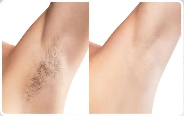 Underarms laser hair removal before and after - illustrative